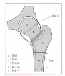 頚部骨折　術式　名前　転子部