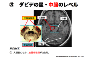 脳画像の見方　ミッキーマウス　大脳脚