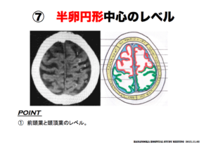 半卵円形中心のレベル　脳画像の見方