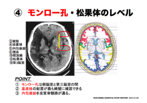 モンロー孔・松果体のレベル　脳画像の見方　内包後脚