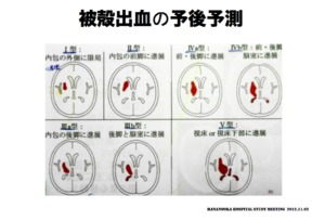 被殻出血の予後予測　脳画像