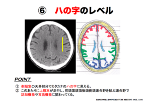 脳画像の見方　八の字のレベル