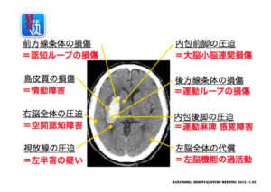 被殻の予後予測　脳　症状