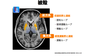 被殻　脳画像　ループ　症状