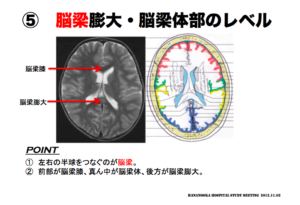 脳梁膨大・脳梁体部の見方　脳画像　