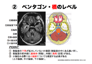 ペンタゴン・橋のレベル　脳画像の見方　側脳室　小脳脚