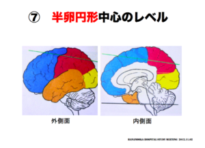 半卵円形中心のレベル　脳画像の見方