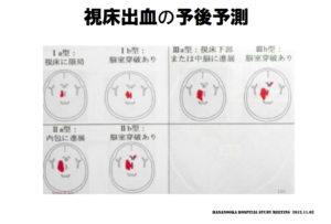 視床出血の予後予測　脳画像から予測　脳室穿破