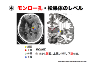 モンロー孔　松果体のレベル　脳画像の見方　麻痺