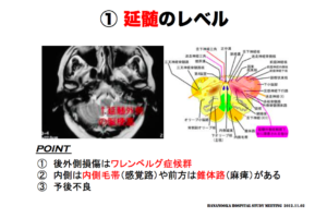延髄のレベル 　脳画像の見方　内側毛帯