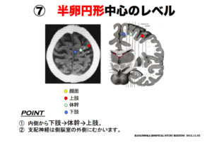 半卵円形中心のレベル　脳画像　麻痺の程度